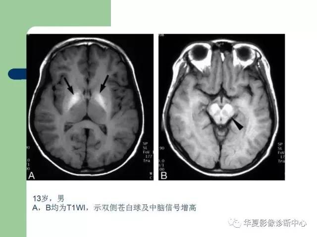 【PPT】颅内对称性病变的诊断