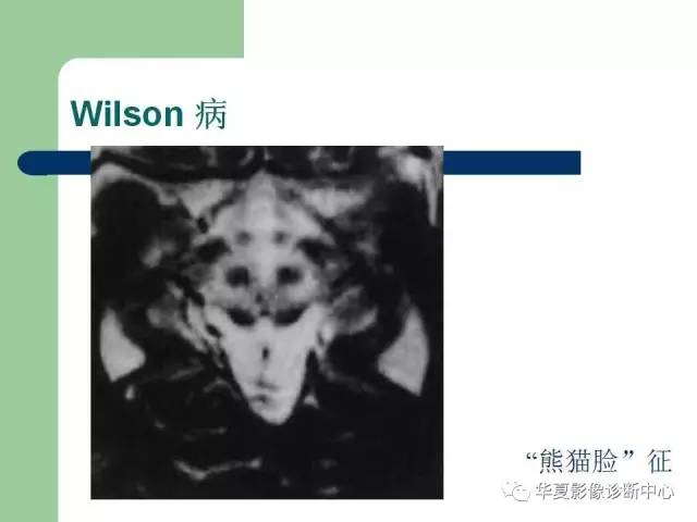 【PPT】颅内对称性病变的诊断