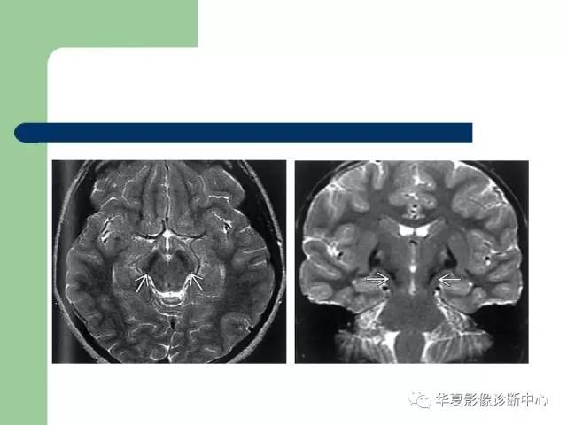 【PPT】颅内对称性病变的诊断