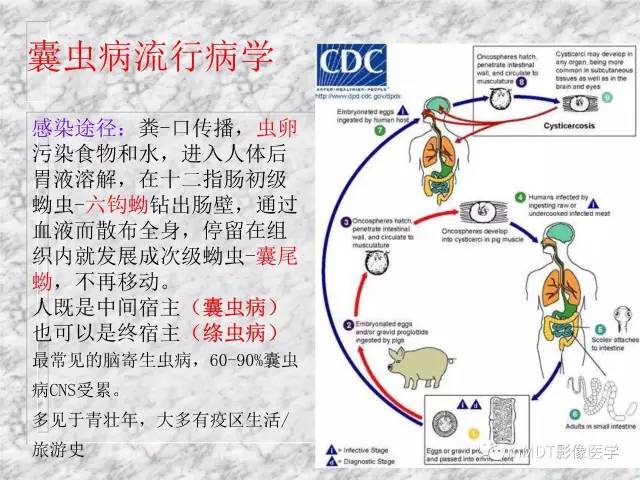 颅内感染性疾病——寄生虫病