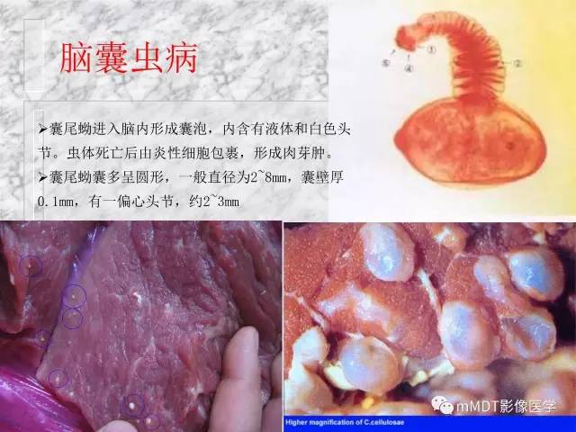 颅内感染性疾病——寄生虫病