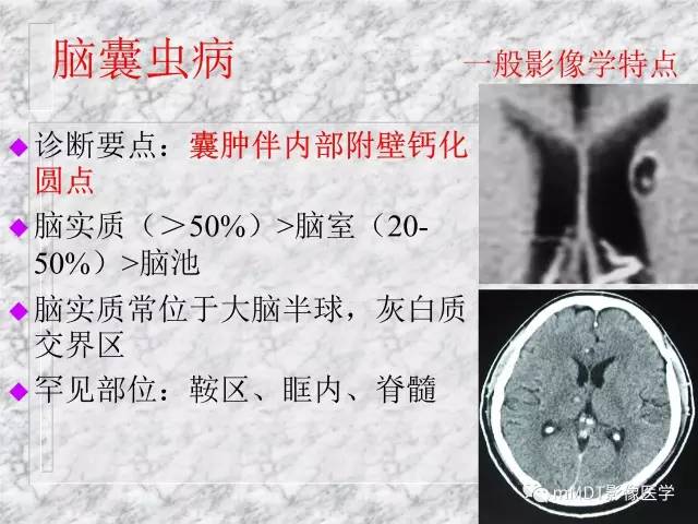 颅内感染性疾病——寄生虫病