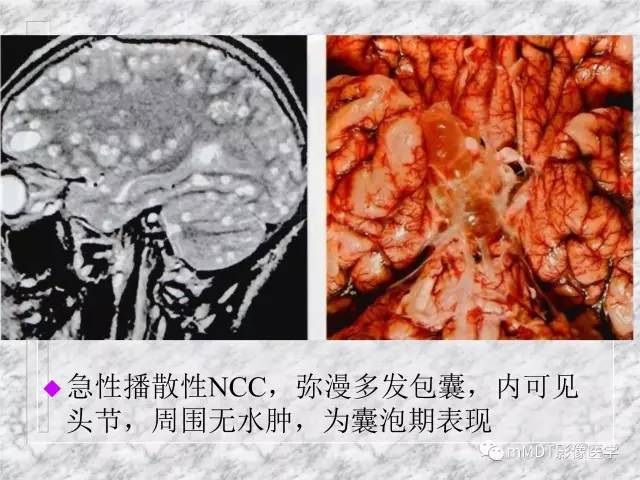 颅内感染性疾病——寄生虫病