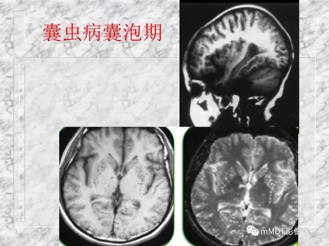 颅内感染性疾病——寄生虫病