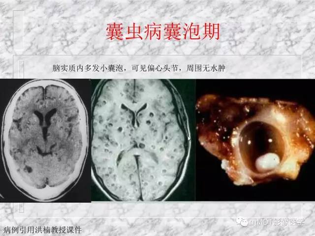 颅内感染性疾病——寄生虫病