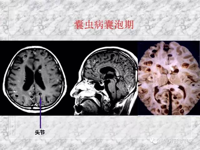 颅内感染性疾病——寄生虫病