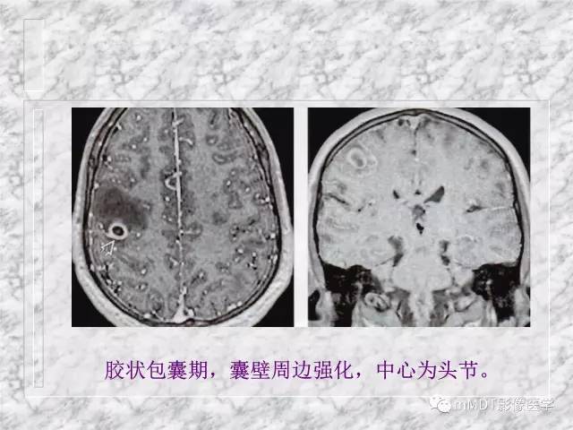 颅内感染性疾病——寄生虫病