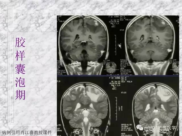 颅内感染性疾病——寄生虫病