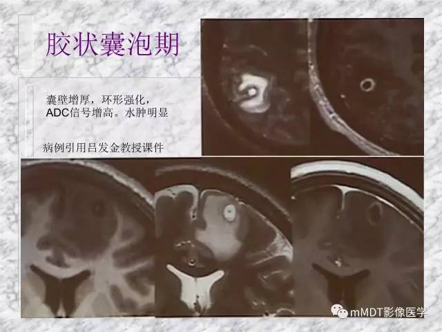 颅内感染性疾病——寄生虫病