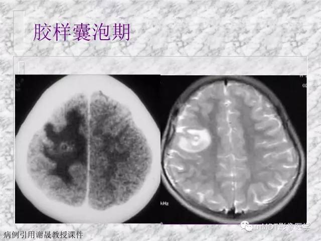 颅内感染性疾病——寄生虫病