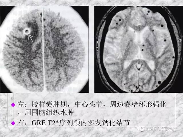 颅内感染性疾病——寄生虫病