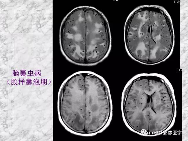 颅内感染性疾病——寄生虫病