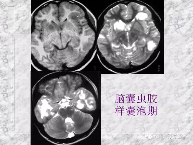 颅内感染性疾病——寄生虫病