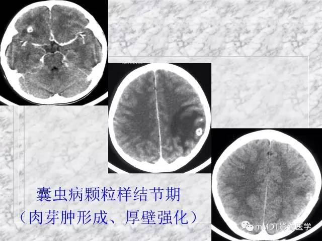 颅内感染性疾病——寄生虫病