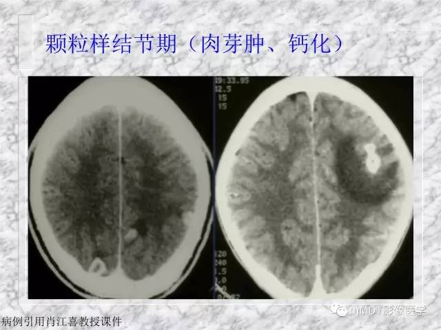 颅内感染性疾病——寄生虫病