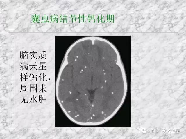 颅内感染性疾病——寄生虫病