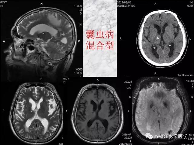 颅内感染性疾病——寄生虫病