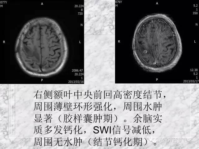 颅内感染性疾病——寄生虫病