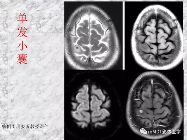颅内感染性疾病——寄生虫病