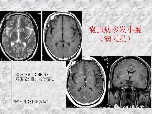 颅内感染性疾病——寄生虫病