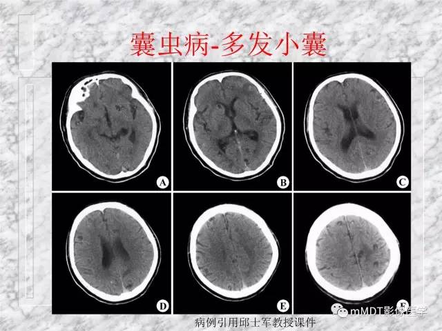 颅内感染性疾病——寄生虫病