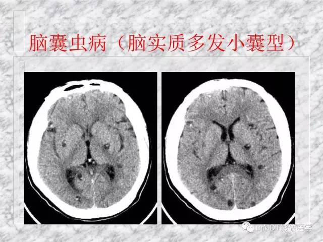 颅内感染性疾病——寄生虫病