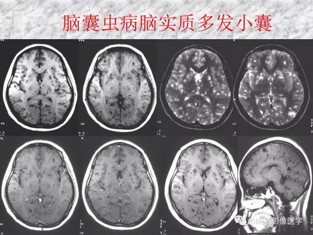 颅内感染性疾病——寄生虫病