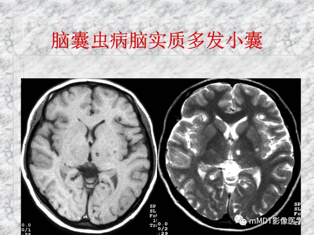颅内感染性疾病——寄生虫病