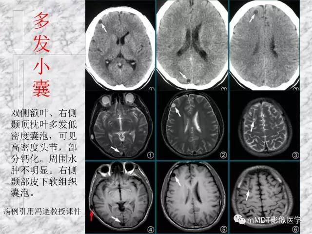 颅内感染性疾病——寄生虫病