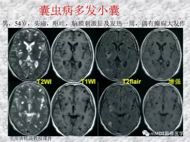 颅内感染性疾病——寄生虫病