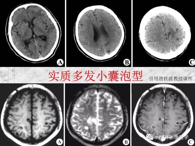 颅内感染性疾病——寄生虫病
