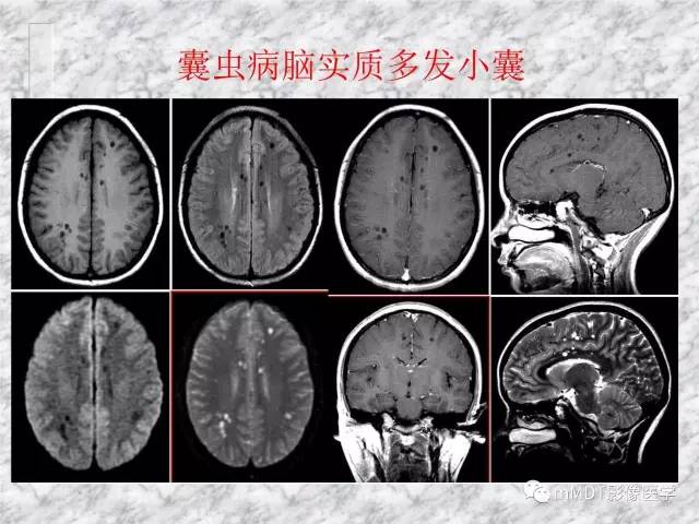 颅内感染性疾病——寄生虫病