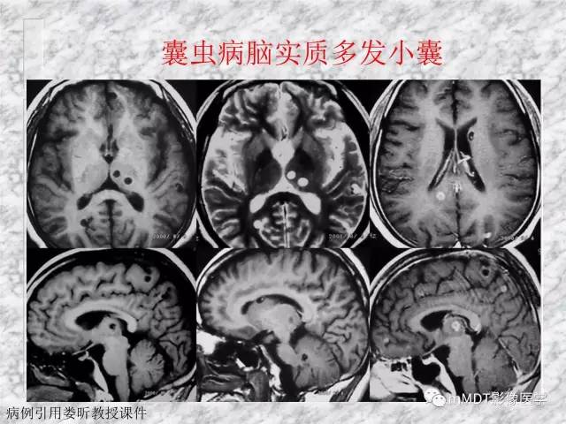颅内感染性疾病——寄生虫病