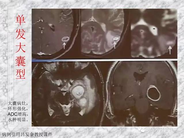 颅内感染性疾病——寄生虫病