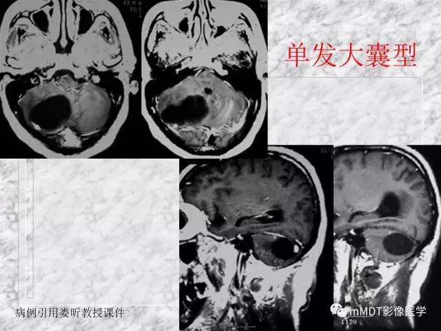 颅内感染性疾病——寄生虫病