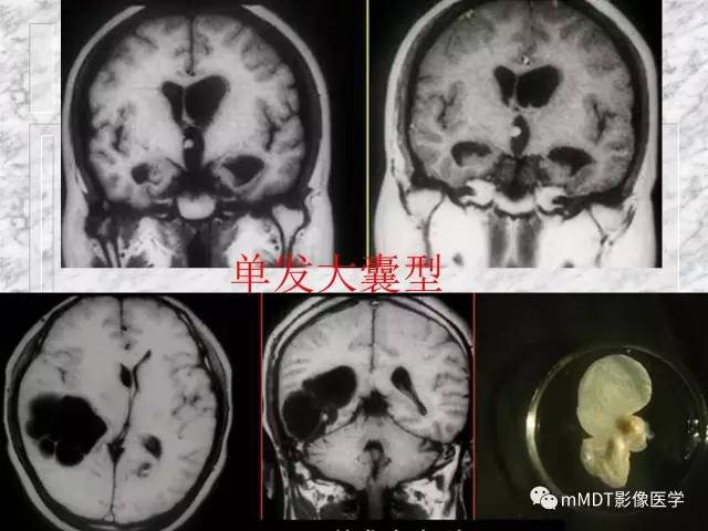 颅内感染性疾病——寄生虫病