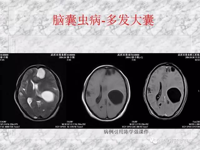 颅内感染性疾病——寄生虫病