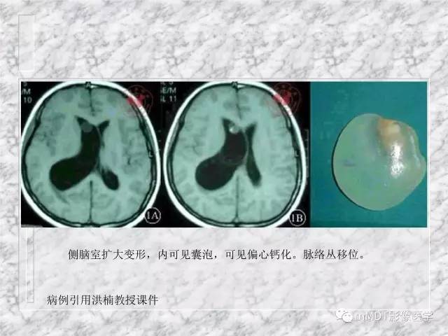颅内感染性疾病——寄生虫病