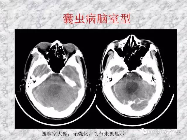 颅内感染性疾病——寄生虫病