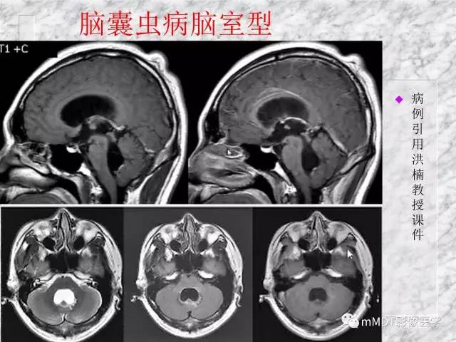 颅内感染性疾病——寄生虫病