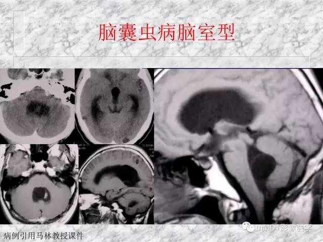 颅内感染性疾病——寄生虫病