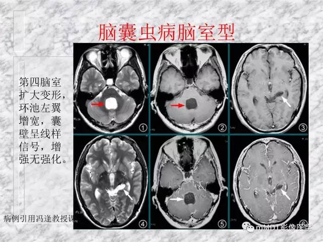 颅内感染性疾病——寄生虫病