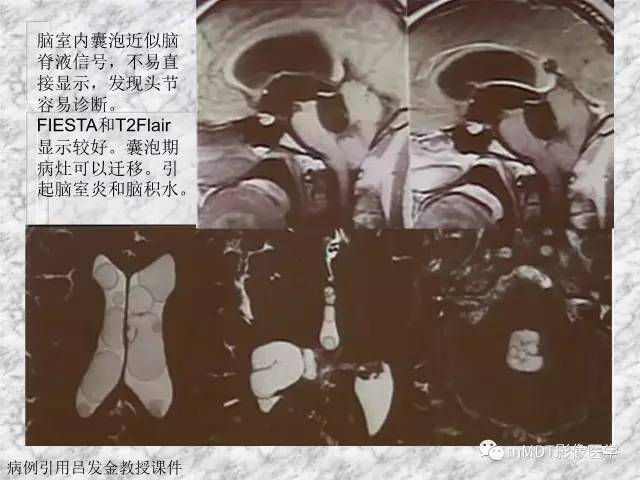 颅内感染性疾病——寄生虫病