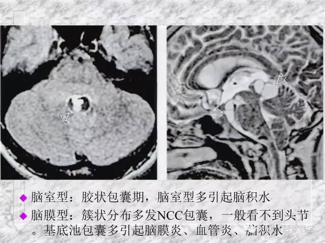 颅内感染性疾病——寄生虫病