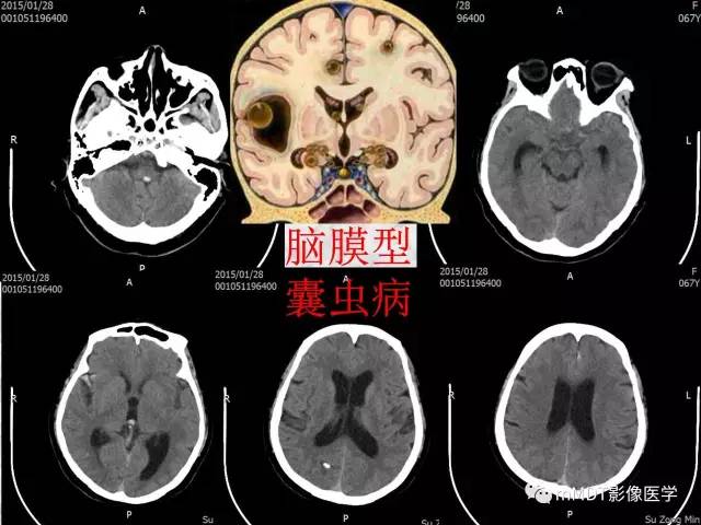 颅内感染性疾病——寄生虫病