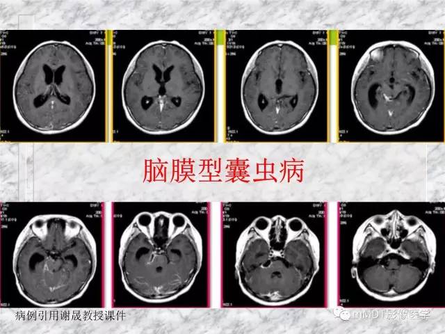 颅内感染性疾病——寄生虫病