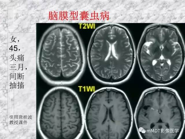 颅内感染性疾病——寄生虫病