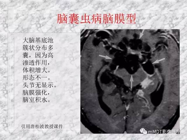 颅内感染性疾病——寄生虫病