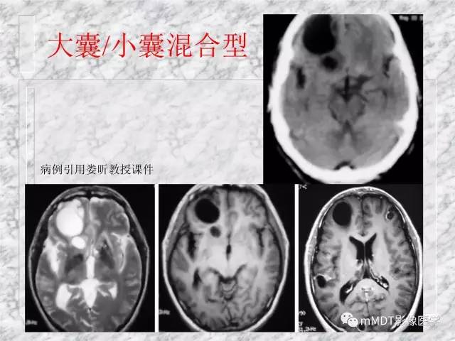 颅内感染性疾病——寄生虫病
