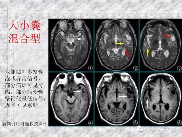 颅内感染性疾病——寄生虫病